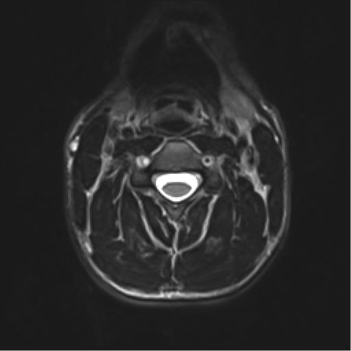 Normal trauma cervical spine (Radiopaedia 41017-43762 D 18).png