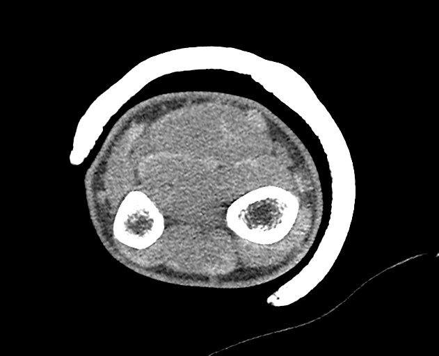Normal wrist CT (Radiopaedia 41425-44297 Axial non-contrast 51).png