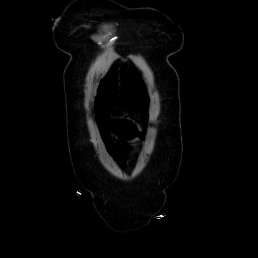 Obstructive distal colonic adenocarcinoma causing cecal perforation (Radiopaedia 86830-102989 C 40).jpg