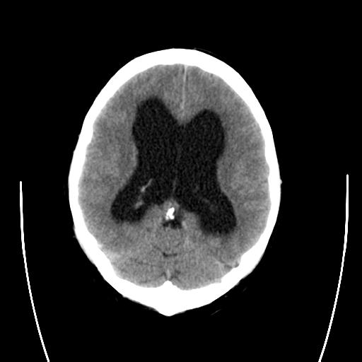 File:Obstructive hydrocephalus (Radiopaedia 30453-31119 C 1).jpg