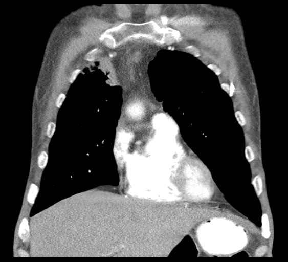File:Obstructive superior vena cava tumor thrombus (Radiopaedia 28046-28306 B 14).jpg