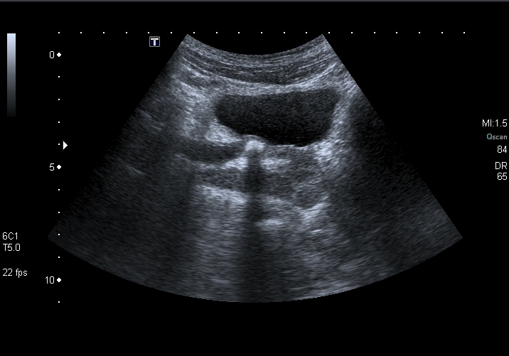 File:Obstructive uropathy and urolithiasis on ultrasound (Radiopaedia 25562-25758 G 1).jpg