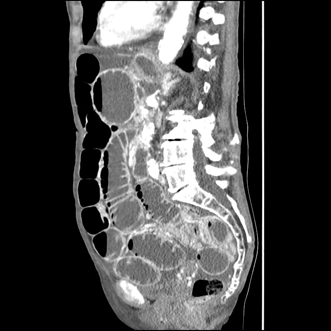 Obturator hernia causing small bowel obstruction (Radiopaedia 65522-74612 C 44).jpg