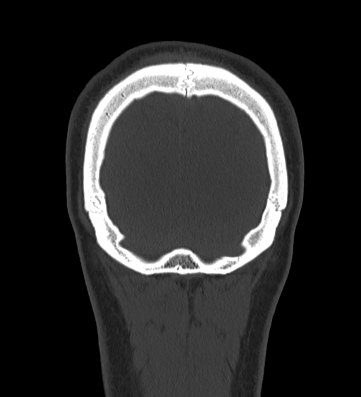 Occipital spur and Currarino type A atlas anomaly (Radiopaedia 87027-103285 Coronal bone window 129).jpg