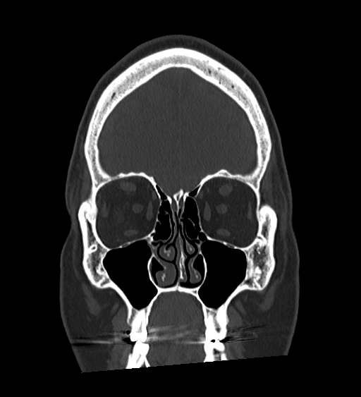 Occipital spur and Currarino type A atlas anomaly (Radiopaedia 87027-103285 Coronal bone window 43).jpg