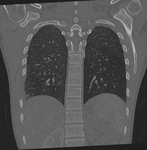 File:Traumatic renal artery dissection and pancreatic transection (Radiopaedia 37061-38739 Coronal 22).png