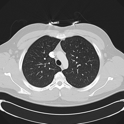 File:'Bovine' aortic arch (Radiopaedia 33554-34637 Axial lung window 18).png