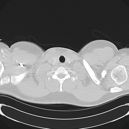 'Bovine' aortic arch (Radiopaedia 33554-34637 Axial lung window 2).png