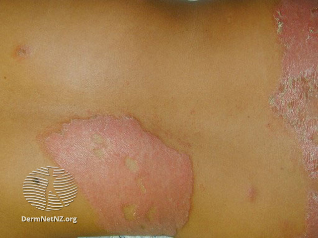 File:(DermNet NZ bacterial-leprosy3).jpg
