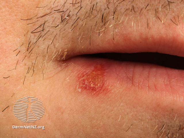 (DermNet NZ herpes-simplex-labialis-34).jpg