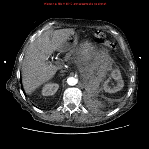 Abdominal aortic aneurysm- extremely large, ruptured (Radiopaedia 19882-19921 Axial C+ arterial phase 18).jpg