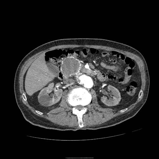 Abdominal aortic aneurysm (Radiopaedia 13341-13340 Axial C+ arterial phase 82).jpg