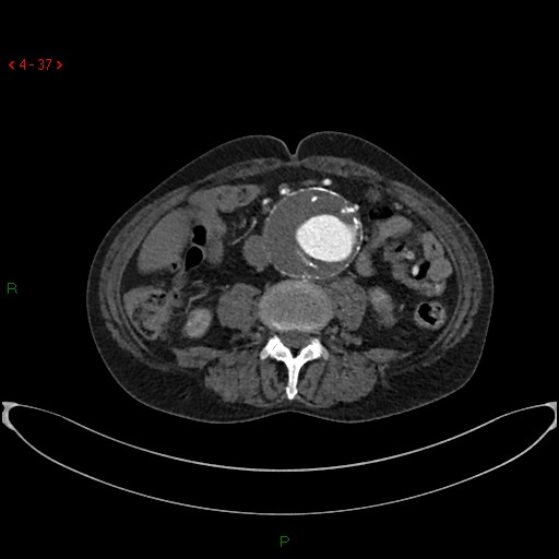 File:Abdominal aortic aneurysm (Radiopaedia 16155-15834 Axial C+ arterial phase 17).jpg