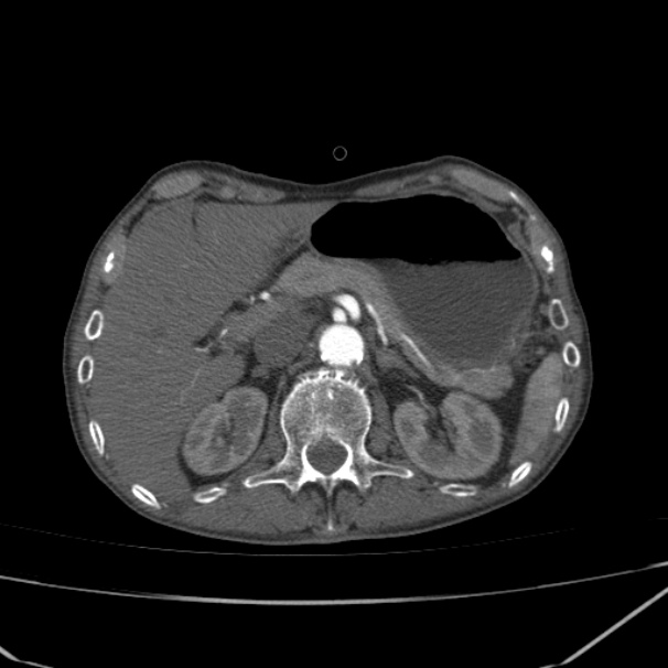 Abdominal aortic aneurysm (Radiopaedia 23703-23856 Axial C+ arterial phase 17).jpg