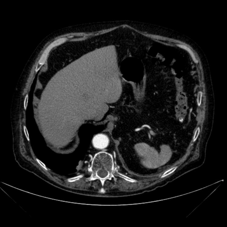 Abdominal aortic aneurysm (Radiopaedia 25855-26001 Axial C+ arterial phase 30).jpg