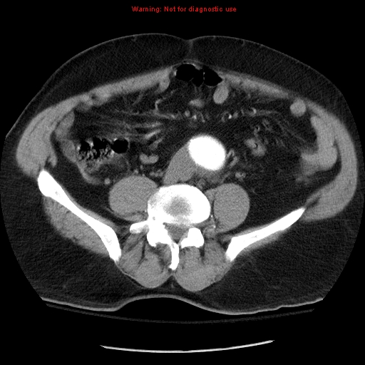 Abdominal aortic aneurysm (Radiopaedia 8190-9038 Axial C+ arterial phase 53).jpg