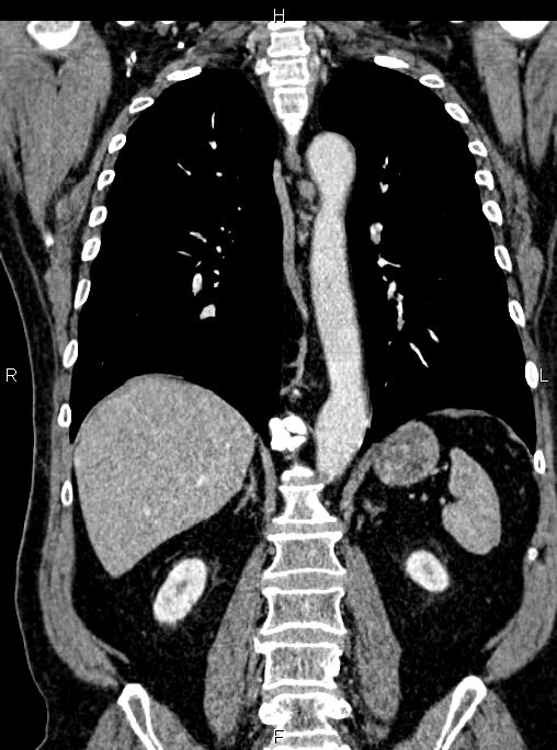 Abdominal aortic aneurysm (Radiopaedia 83094-97462 Coronal renal cortical phase 61).jpg