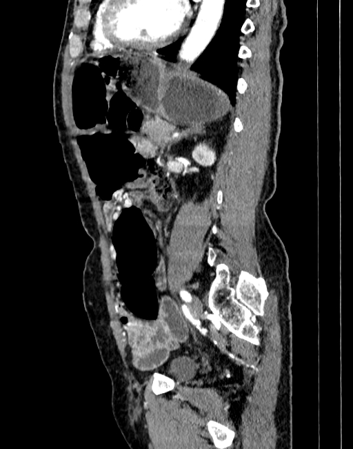 Abdominal aortic aneurysm (Radiopaedia 83581-98689 Sagittal C+ arterial phase 73).jpg