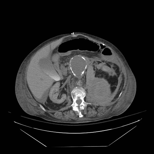 Abdominal aortic aneurysm - impending rupture (Radiopaedia 19233-19247 Axial non-contrast 75).jpg