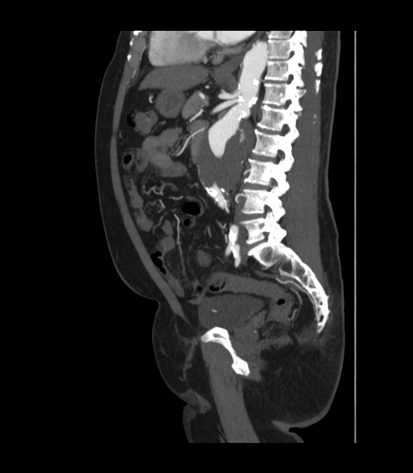 Abdominal aortic aneurysm with thrombus fissuration (Radiopaedia 46218-50618 Sagittal C+ arterial phase 34).jpg