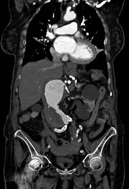 Abdominal aortic aneurysm with thrombus fissuration (Radiopaedia 73192-83919 Coronal C+ arterial phase 36).jpg