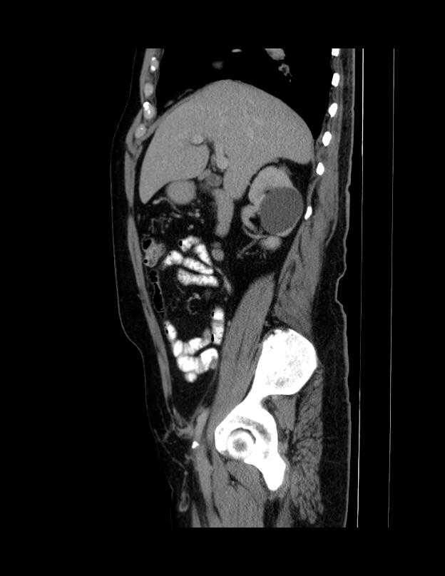 Abdominal lymphoma - with sandwich sign (Radiopaedia 53486-59492 Sagittal C+ portal venous phase 54).jpg