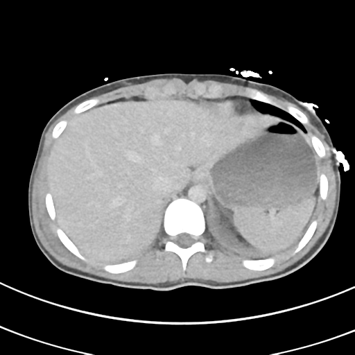 File:Abdominal multi-trauma - devascularised kidney and liver, spleen and pancreatic lacerations (Radiopaedia 34984-36486 Axial C+ delayed 10).png