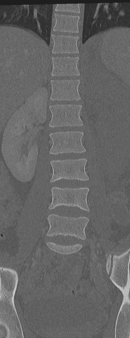 Abdominal multi-trauma - devascularised kidney and liver, spleen and pancreatic lacerations (Radiopaedia 34984-36486 Coronal bone window 28).png