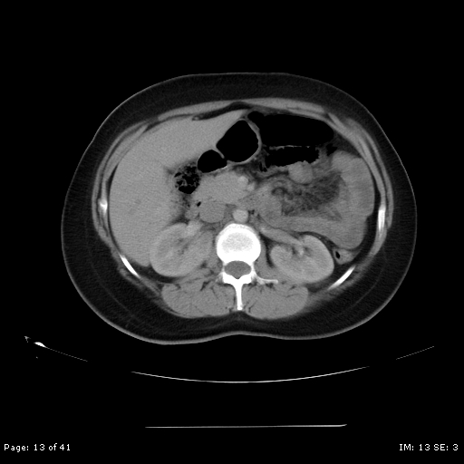 File:Abdominal wall endometriosis (Radiopaedia 25723-25885 Axial C+ portal venous phase 13).jpg
