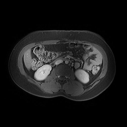 File:Abdominal wall endometriosis (Radiopaedia 83702-98847 Axial T1 C+ fat sat 4).jpg