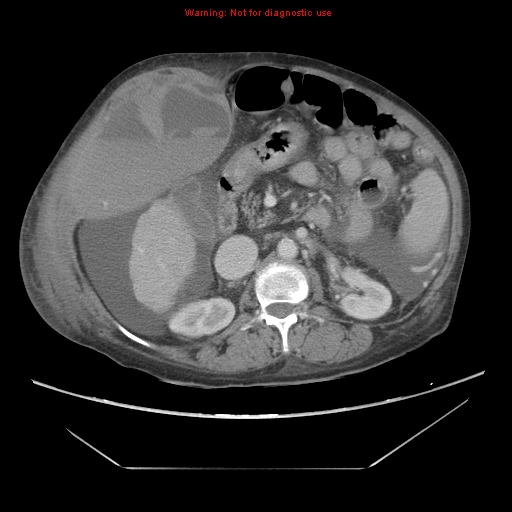 File:Abdominal wall hematoma (Radiopaedia 9427-10112 Axial C+ portal venous phase 42).jpg