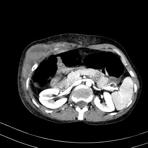 File:Abdominal wall hematoma with active bleeding (Radiopaedia 83915-99117 Axial renal cortical phase 17).jpg