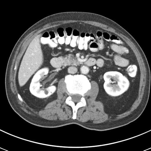 Abdominal wall metastasis from colorectal carcinoma (Radiopaedia 31016-31717 Axial C+ portal venous phase 33).jpg