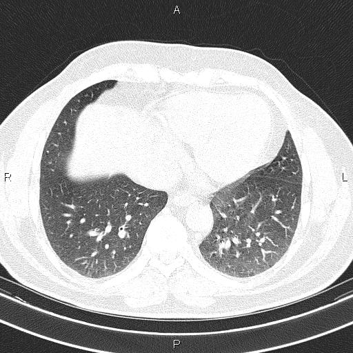Aberrant right subclavian artery (Radiopaedia 87093-103354 Axial lung window 79).jpg