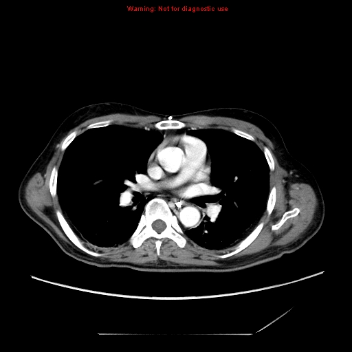 File:Aberrant right subclavian artery (Radiopaedia 9379-10071 Axial C+ arterial phase 32).jpg