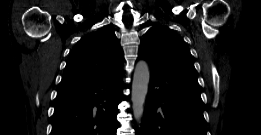 Accesory rib joint (Radiopaedia 71987-82452 Coronal bone window 21).jpg