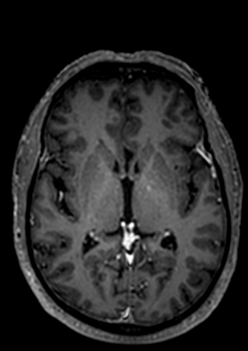 Accessory middle cerebral artery (Radiopaedia 73114-83828 Axial T1 C+ 31).jpg