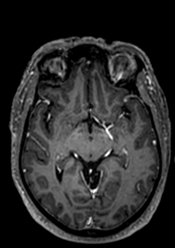 Accessory middle cerebral artery (Radiopaedia 73114-83828 Axial T1 C+ 58).jpg