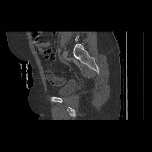 File:Acetabular fracture (Radiopaedia 13193-13212 Sagittal bone window 36).jpg