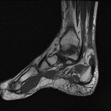File:Achilles tendon tear (Radiopaedia 77615-89819 Sagittal T1 6).jpg