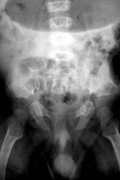 File:Achondroplasia (Radiopaedia 11160-11525 A 1).jpg