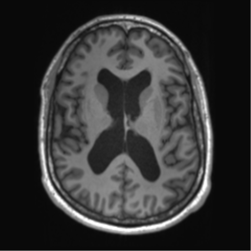 File:Achondroplasia (Radiopaedia 65109-74105 Axial T1 24).png