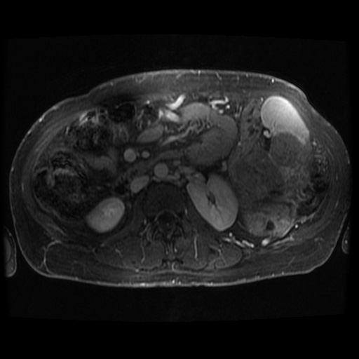 Acinar cell carcinoma of the pancreas (Radiopaedia 75442-86668 Axial T1 C+ fat sat 29).jpg
