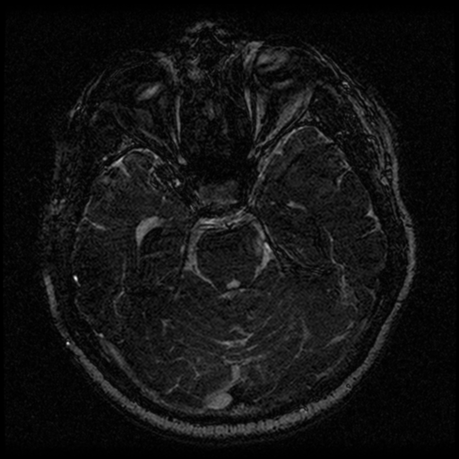 Acoustic schwannoma (Radiopaedia 33045-34060 Axial T2 65).png