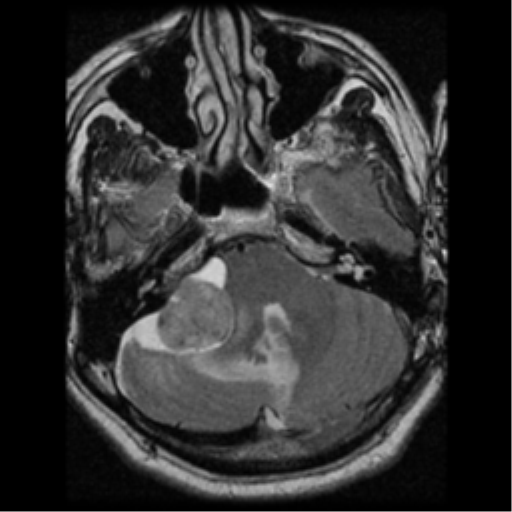 File:Acoustic schwannoma (Radiopaedia 39170-41387 Axial T2 8).png