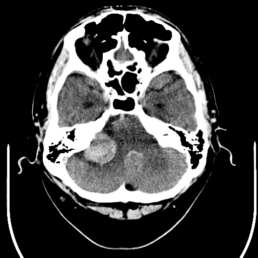 File:Acoustic schwannoma (Radiopaedia 39170-41389 Axial C+ 6).png