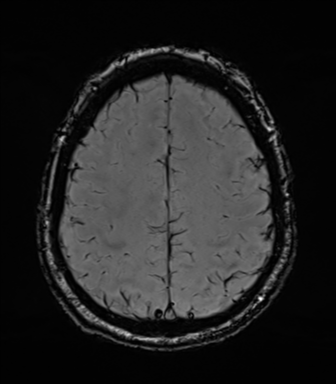 File:Acoustic schwannoma (Radiopaedia 50846-56358 Axial SWI 73).png