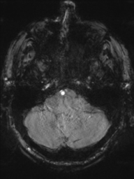 Acoustic schwannoma (Radiopaedia 55729-62281 Axial SWI 10).png
