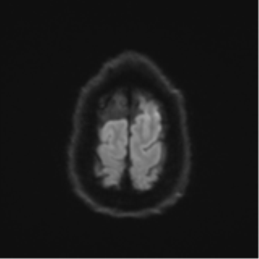 Acoustic schwannoma (Radiopaedia 55729-62281 E 53).png