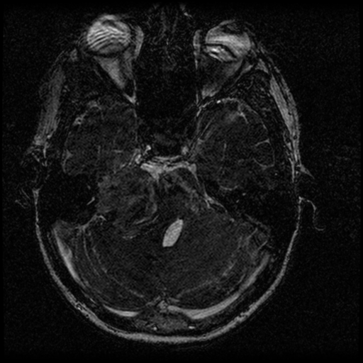 Acoustic schwannoma - eroding petrous apex (Radiopaedia 39674-42004 Axial T2 52).png